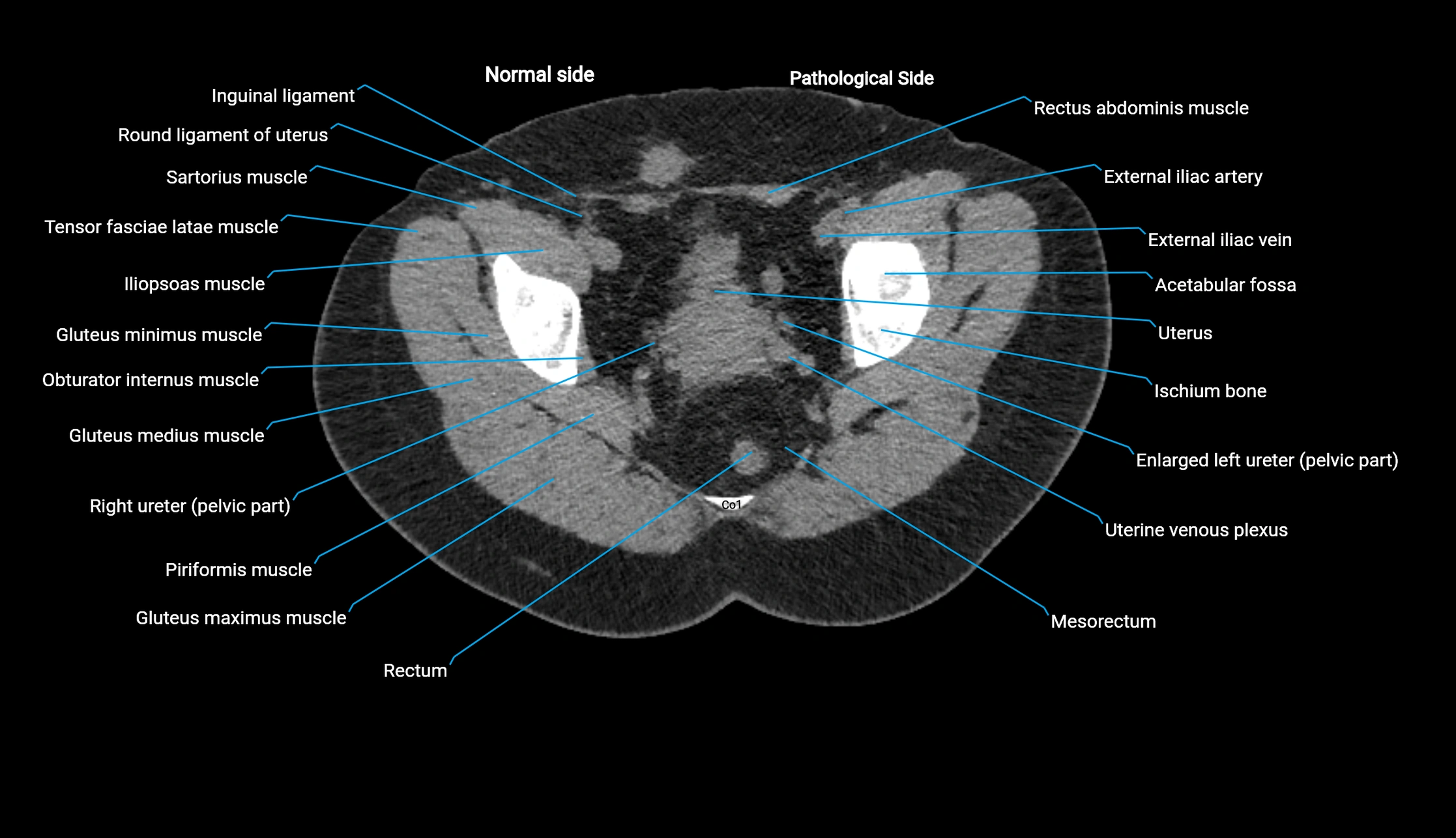CT KUB axial cross sectional anatomy  radiology image -img-00201-00149.webp